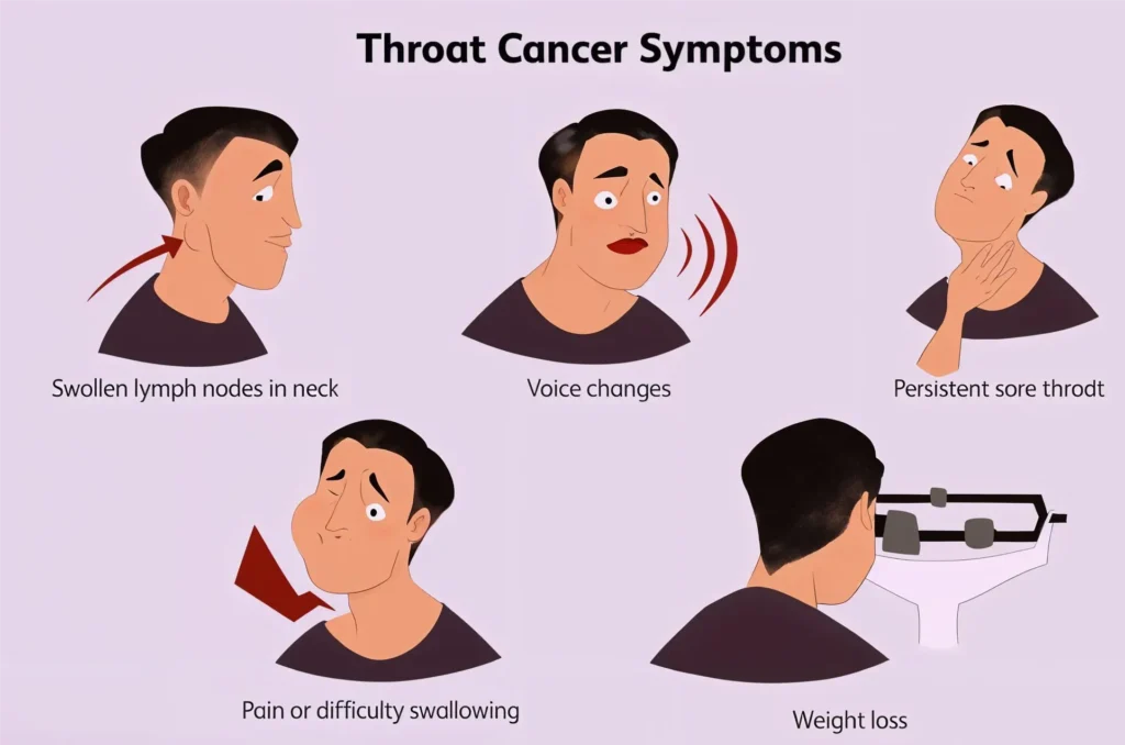 Is Throat Cancer Curable