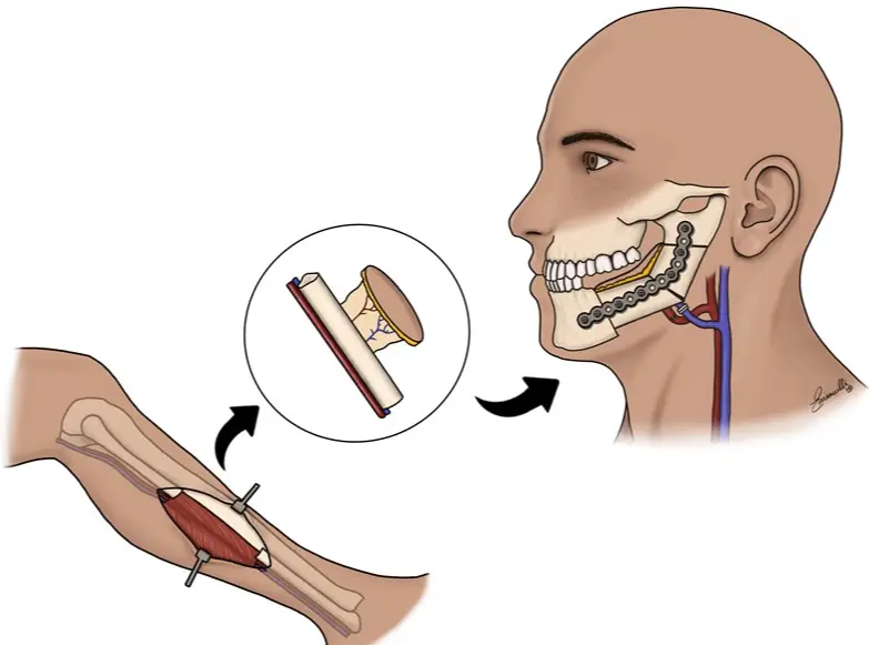 Head and Neck Reconstructive Surgery