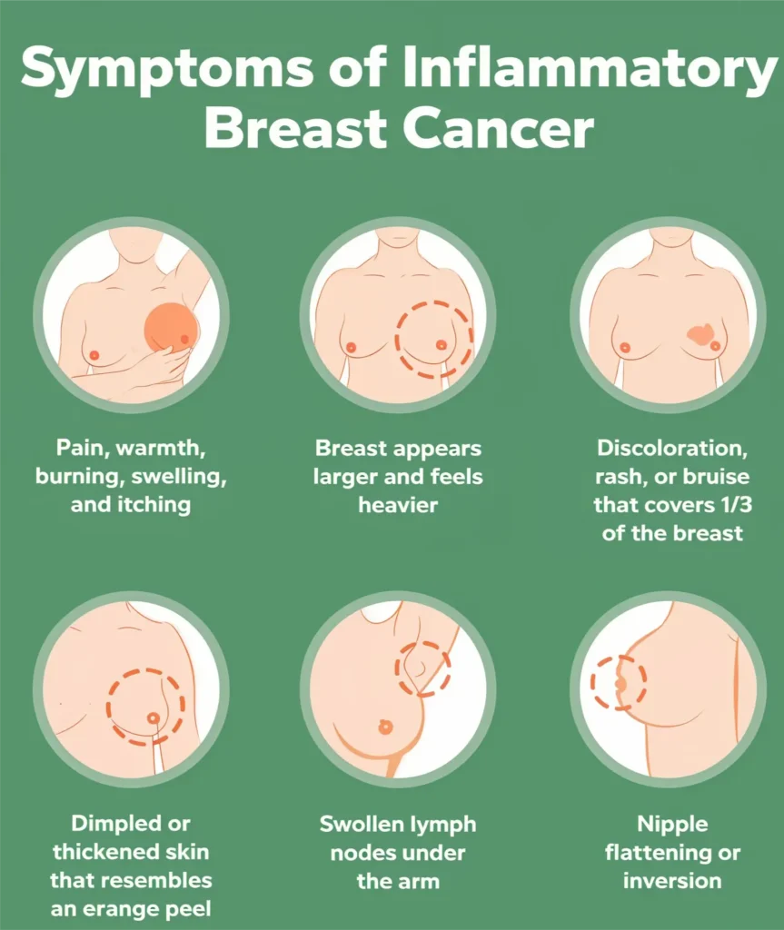 Inflammatory Breast Cancer